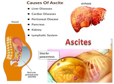 Ascites cause, grades, symptoms, diagnosis and Treatment of cirrhotic ...