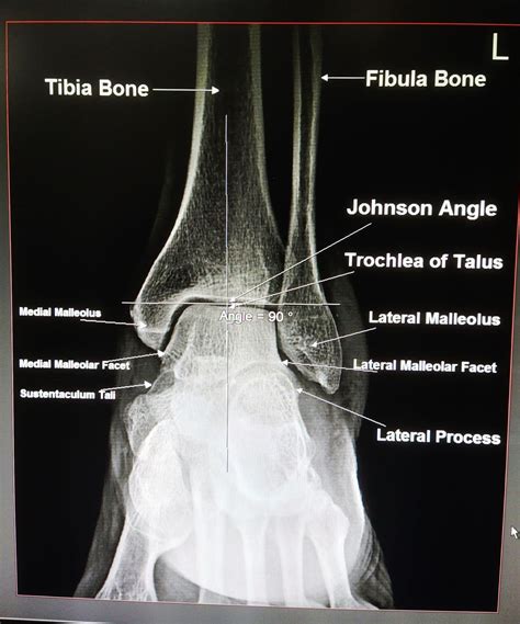 Pin on ankle joint ap view basic Anatomy