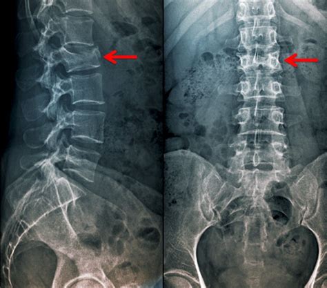 Vertebral Compression Fractures - Injuries; Poisoning - Merck Manuals Professional Edition