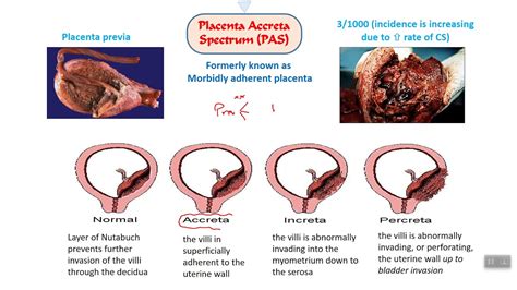 Antepartum hemorrhage / part 4 - YouTube