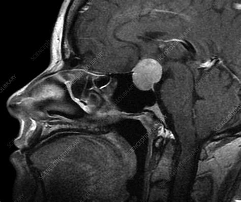 Enlarged pituitary gland, MRI scan - Stock Image - C052/9122 - Science ...