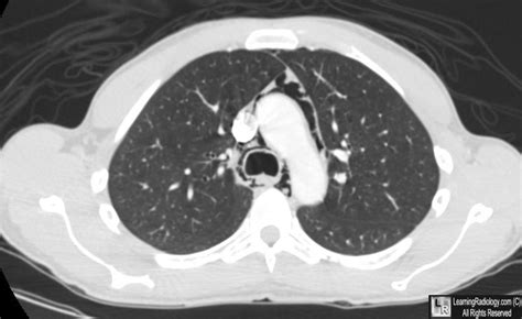 LearningRadiology - pneumomediastinum, mediastinal, emphysema, chest, mediastinum