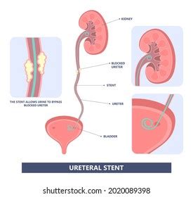 37 Ureterostomy Images, Stock Photos & Vectors | Shutterstock