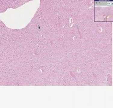 Histopathology Brain--Glioblastoma multiforme - YouTube