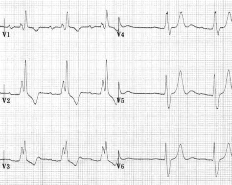 T wave • LITFL • ECG Library Basics