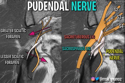 Pudendal Nerve Mri