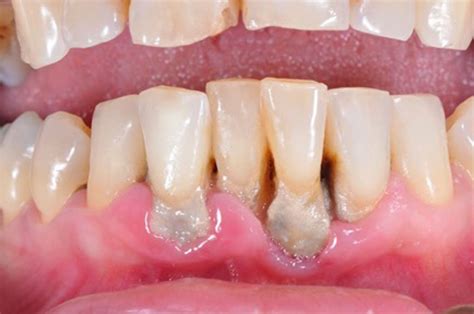 Scientists discover possible new weapon in the fight against gum disease - Bite Magazine