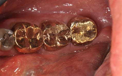 Dental Gold Tooth at David Snyder blog