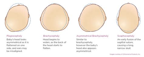 Steeper Clinic What Is Plagiocephaly? - Steeper Clinics