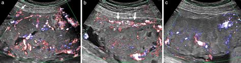 Diagnosis of placenta accreta spectrum using ultra‐high‐frequency probe and Superb Microvascular ...