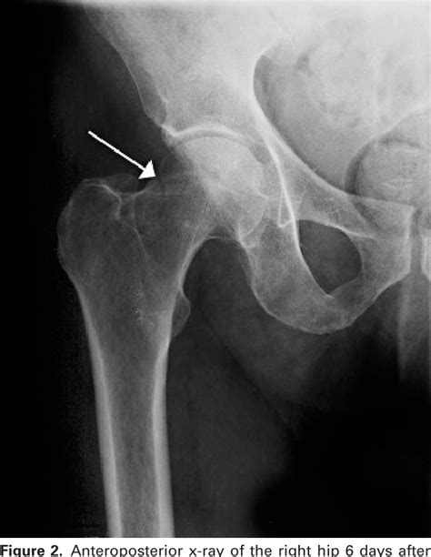 Figure 2 from Bilateral occult hip fracture. | Semantic Scholar