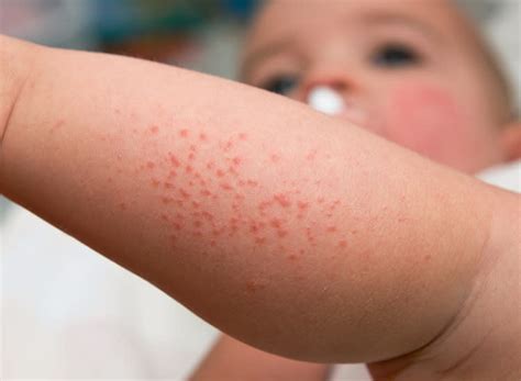 Baby Rashes: Types, Symptoms & More