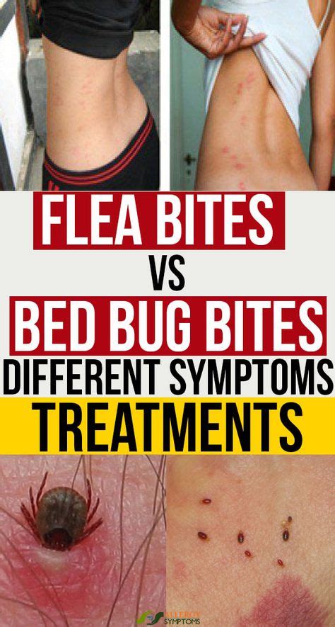 Flea Bites vs. Bed Bug Bites: Different Symptoms, Treatments | Bed bug bites, Bug bites, Types ...