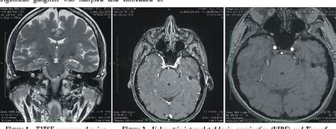 Trigeminal Nerve Nucleus Mri