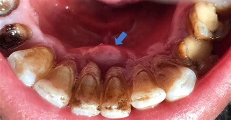 Periodontal Abscess Causes