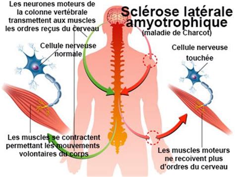 Sclérose latérale amyotrophique (maladie de Charcot) : symptômes, traitement, définition ...