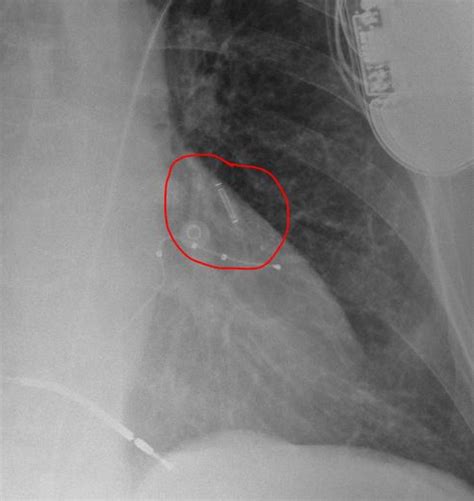 CardioMEMS Device