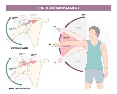 Shoulder Impingement Exercises - Best Advice in 2024