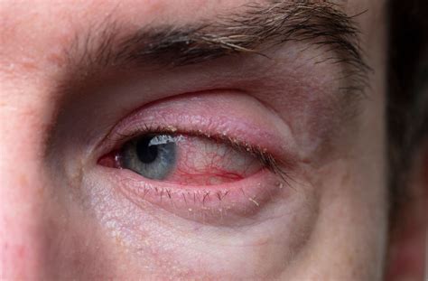 Blepharitis vs Pink Eye: Know the Difference | San Clemente