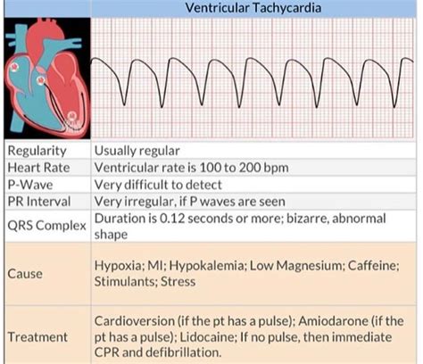 Ventricular Tachycardia | Nursing study tips, Ventricular tachycardia, Nursing school survival