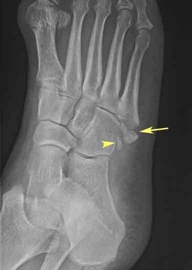 Avulsion of the Fifth Proximal Metatarsal (X-Ray of Foot): Figure: Oblique radiograph of the ...