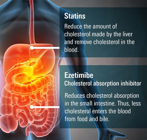 Ezetimibe (Zetia) for high cholesterol