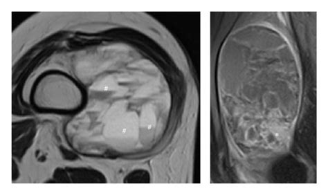 MRI characteristics of soft tissue sarcoma with telangiectatic changes ...