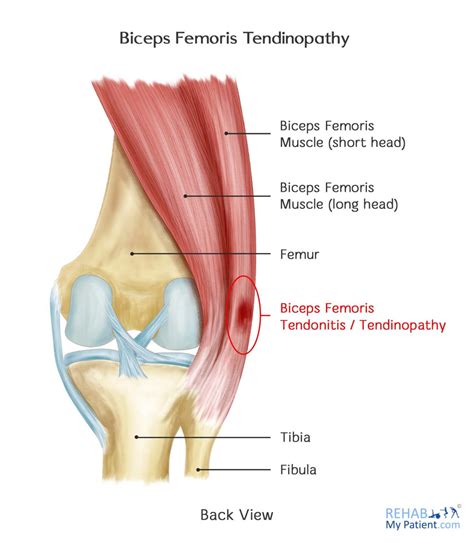 Biceps Femoris Tendinopathy | Rehab My Patient