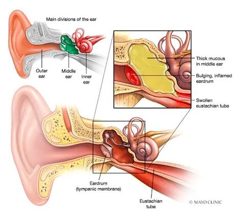 Ear infection (middle ear) | Beacon Health System