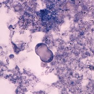 Dientamoeba fragilis Infection | Norway| PDF | PPT| Case Reports ...