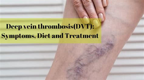 Deep vein thrombosis: Symptoms, Diet and Treatment