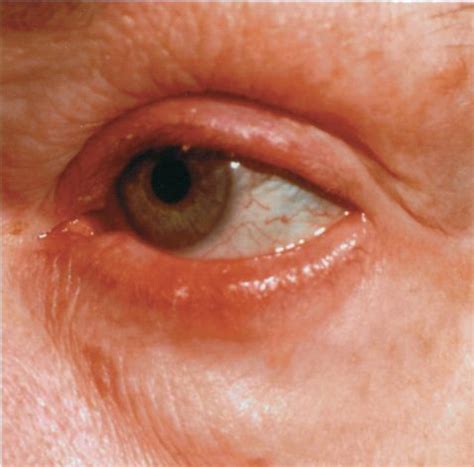 Ocular Rosacea FAQ's - Rosadyn