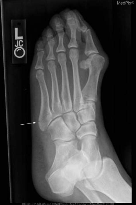 Pseudo Jones Fracture