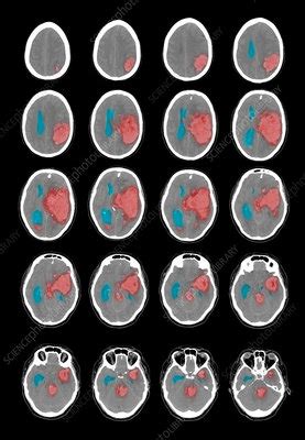 CT Scan of Intracranial Hemorrhage - Stock Image - C003/4548 - Science ...