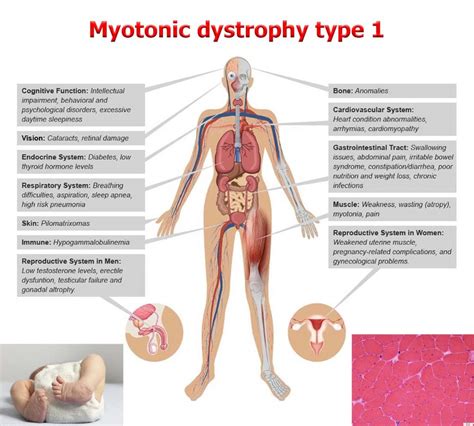 Discovered new therapy to treat myotonic dystrophy type 1 - https://debuglies.com