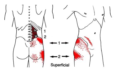 Thoracolumbar Junction Syndrome (TLJS) | AcuSport Education