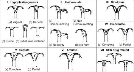 Mullerian Anomaly Surgery | Double Uterus | ACFS