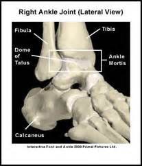 Osteochondral Fractures Of The Talar Dome | Joint Pain Info