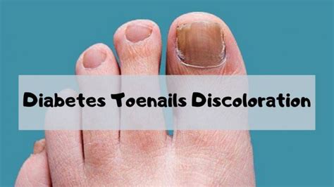 Diabetes Toenails Discoloration - The Causes of This Problem | Keep Fit ...