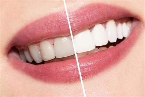 Teeth Whitening Can Help Your Smile Sparkle - Smile Fitness Dental Center Blog