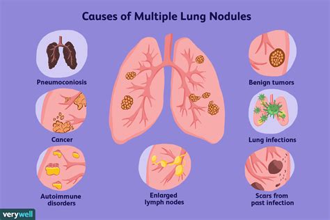 Common Causes of Multiple Lung Nodules