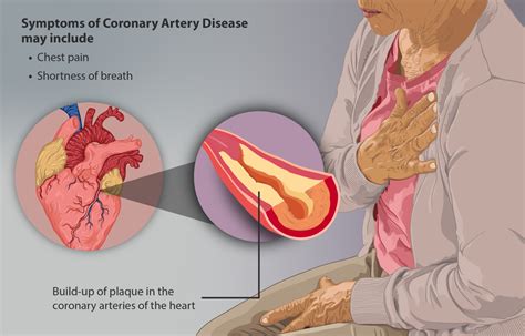 Coronary Artery Disease (CAD) - Physiopedia