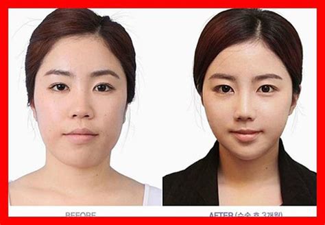 Before and After Photos of Korean Plastic Surgery. Part 2 (62 PICS ...