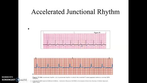 Accelerated Junctional and Junctional Tachycardia - YouTube