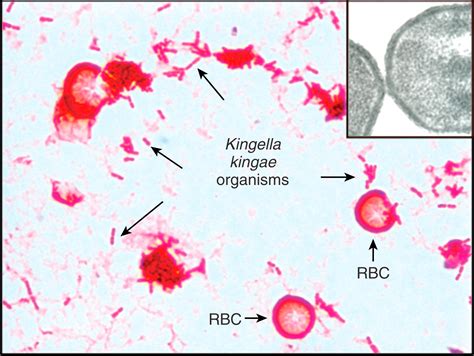 Kingella Species - Clinical Tree