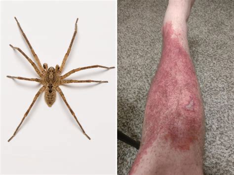 Man Bitten by Spider As He Slept Left in "Immense" Pain, Covered in Rash - Newsweek