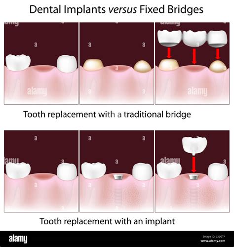 Dental implants versus traditional fixed bridges Stock Photo - Alamy