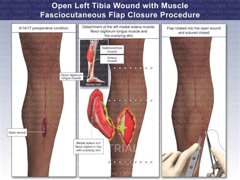 Open Left Tibia Wound with Muscle Fasciocutaneous Flap Closure Pr...