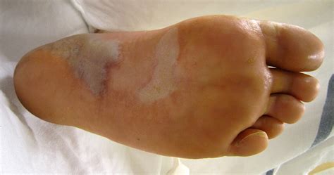 Epidermolysis bullosa – eine seltene Erbkrankheit - MedMix