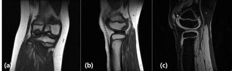 (A, B) MRI study showing a discoid lateral meniscus with a 1.5 by 1.5... | Download Scientific ...